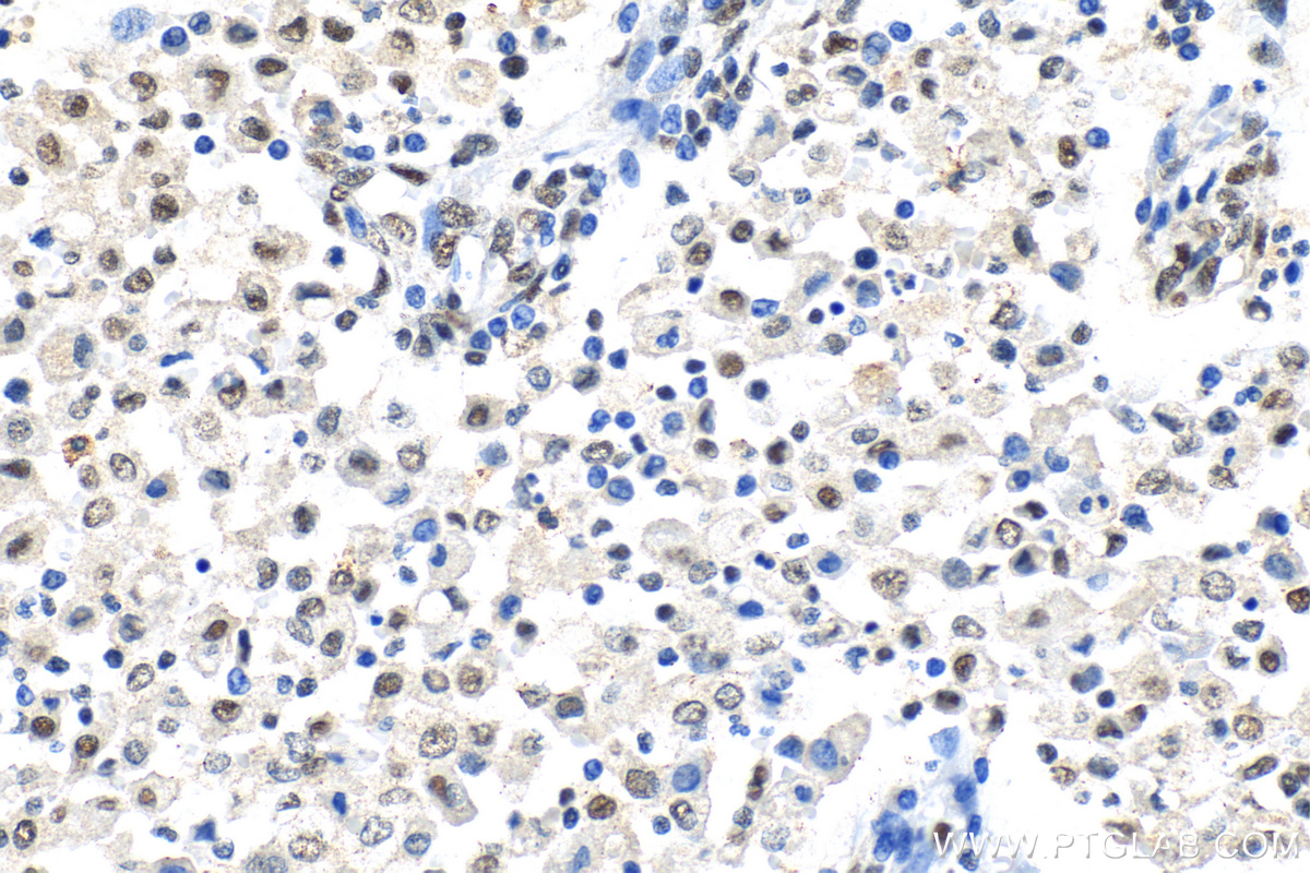 IHC staining of human endometrial cancer using 30304-1-AP