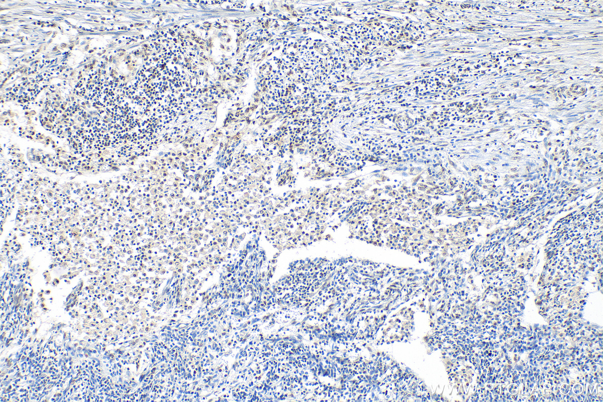 IHC staining of human endometrial cancer using 30304-1-AP