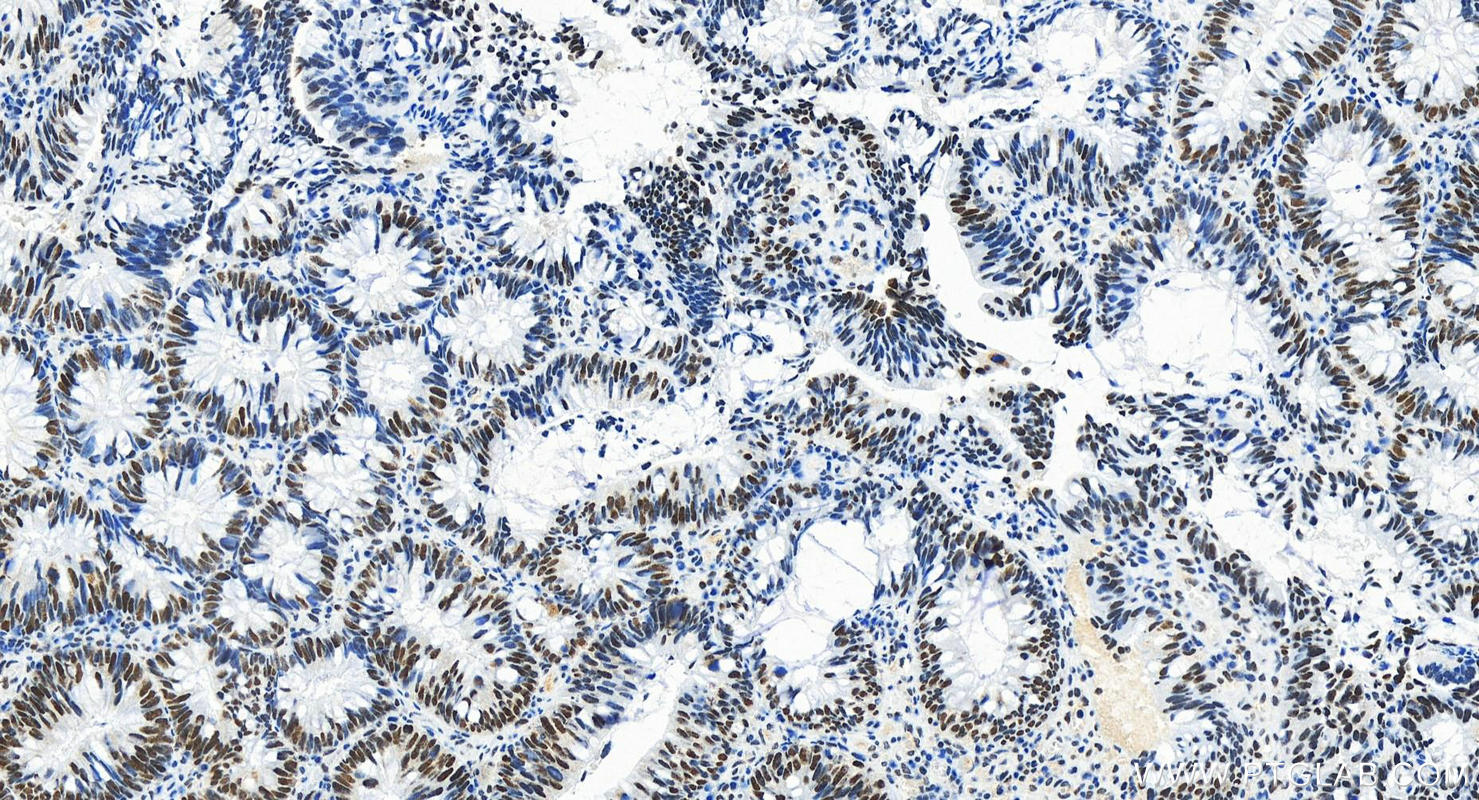 IHC staining of human colon cancer using 83733-3-RR (same clone as 83733-3-PBS)