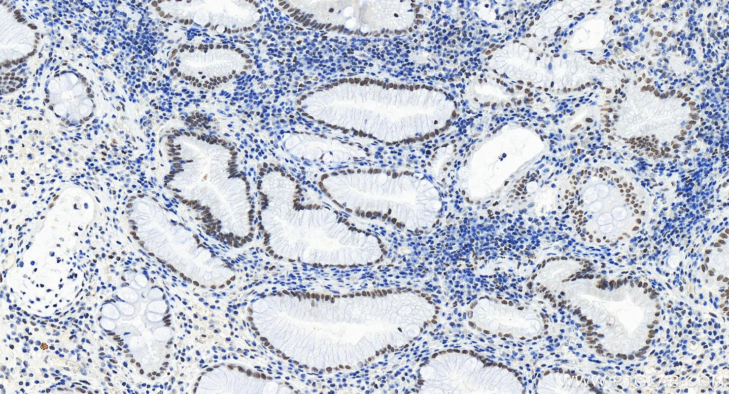 IHC staining of human stomach cancer using 83733-3-RR (same clone as 83733-3-PBS)