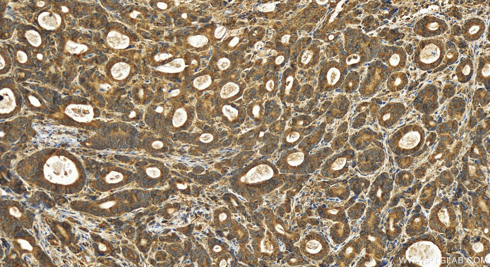 IHC staining of human stomach cancer using 16012-1-AP