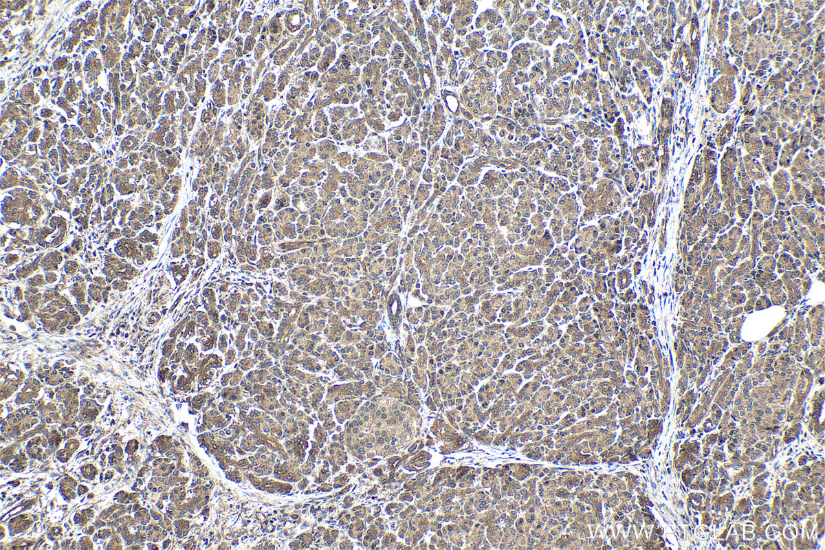 IHC staining of human pancreas cancer using 10090-2-AP