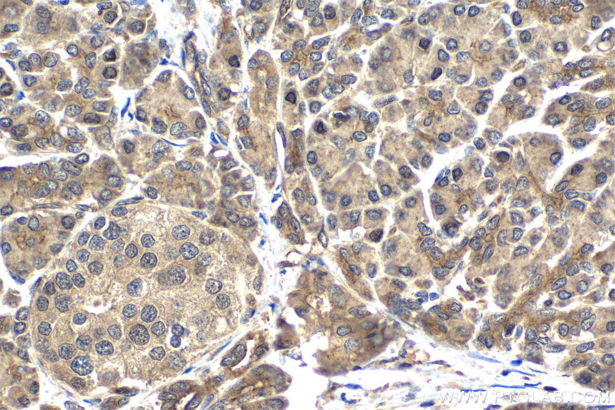 IHC staining of human pancreas cancer using 10090-2-AP