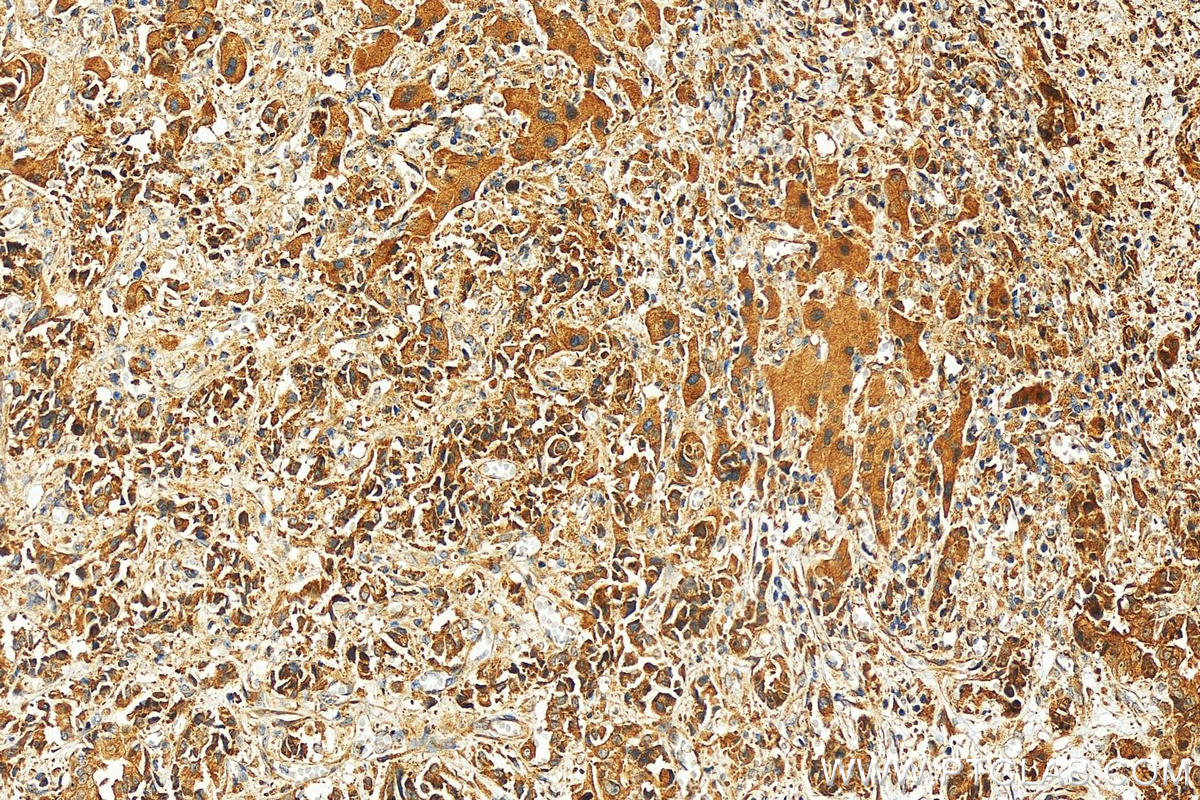 IHC staining of human intrahepatic cholangiocarcinoma using 11694-1-AP