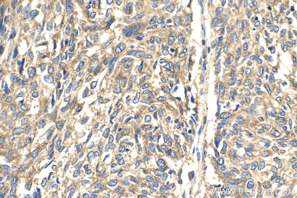 IHC staining of human cervical cancer using 10930-1-AP