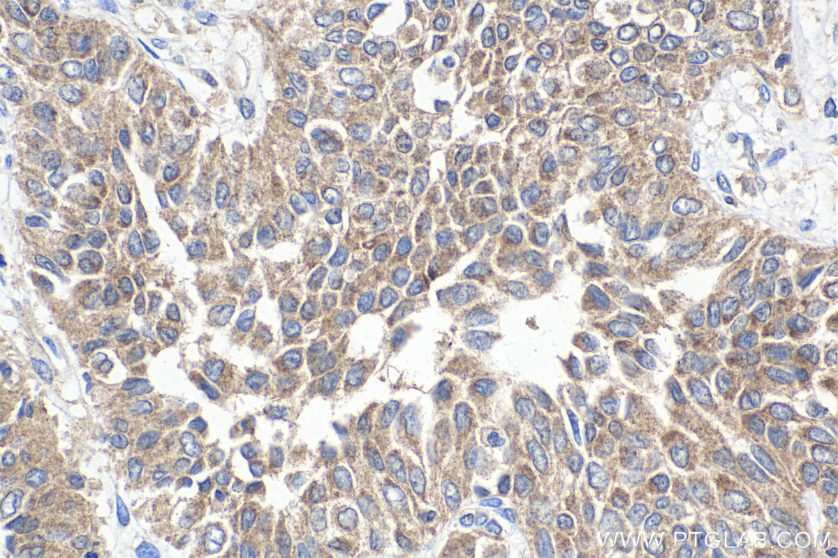 IHC staining of human urothelial carcinoma using 10930-1-AP