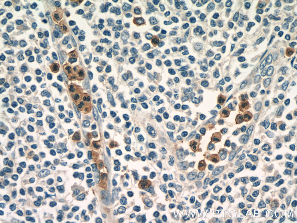 IHC staining of human tonsillitis using 25300-1-AP