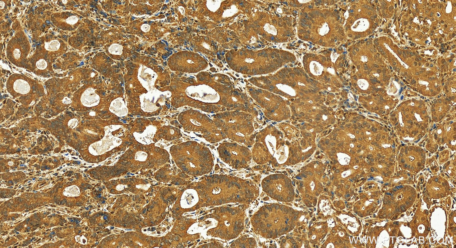 IHC staining of human stomach cancer using 11952-1-AP