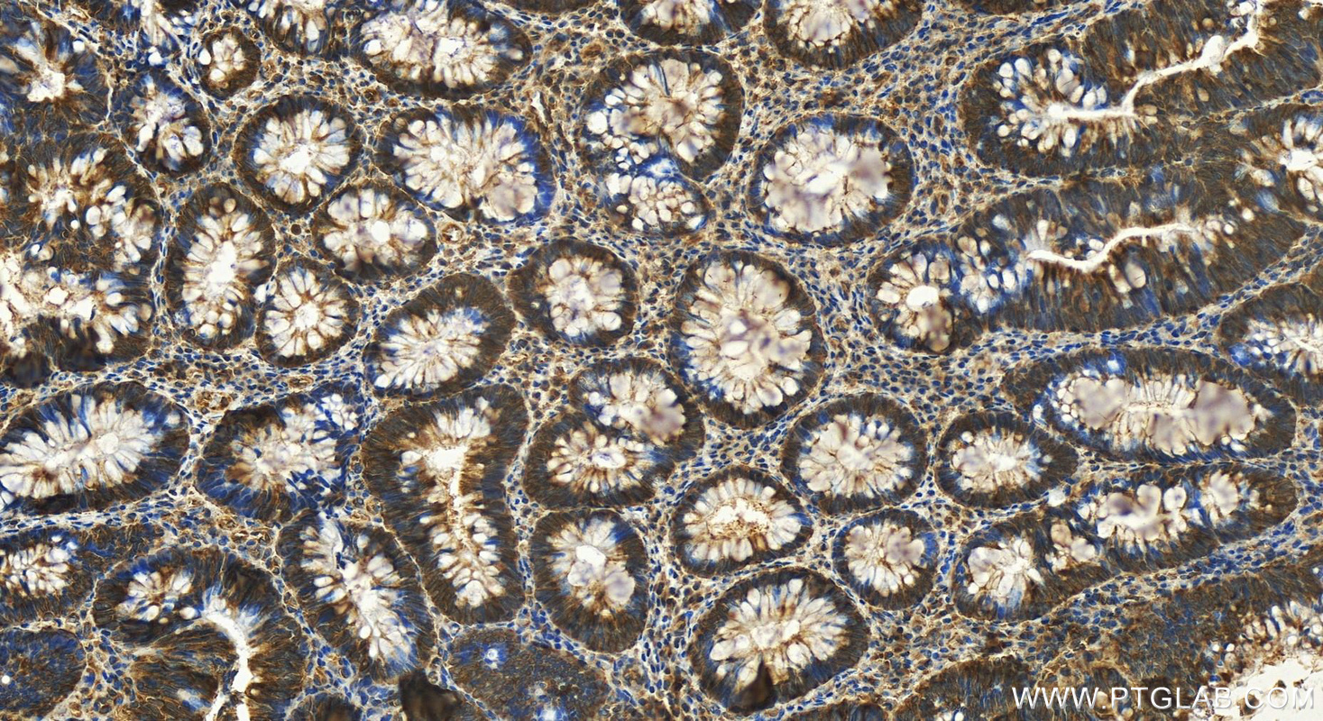 IHC staining of human colon cancer using 11529-1-AP