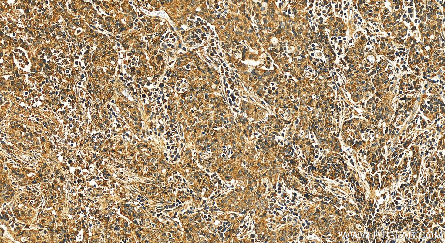 IHC staining of human stomach cancer using 21368-1-AP