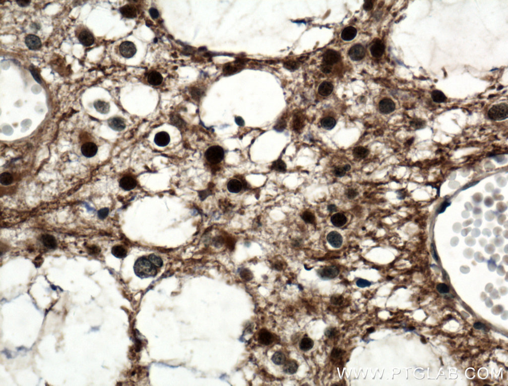 IHC staining of human gliomas using 11400-1-AP