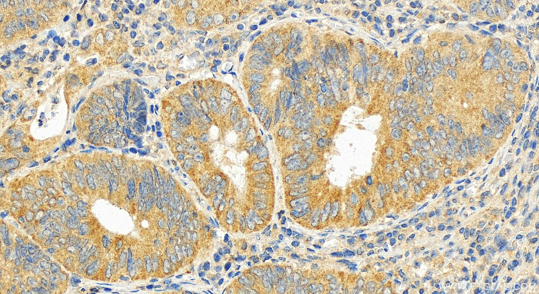 IHC staining of human colon cancer using 16882-1-AP