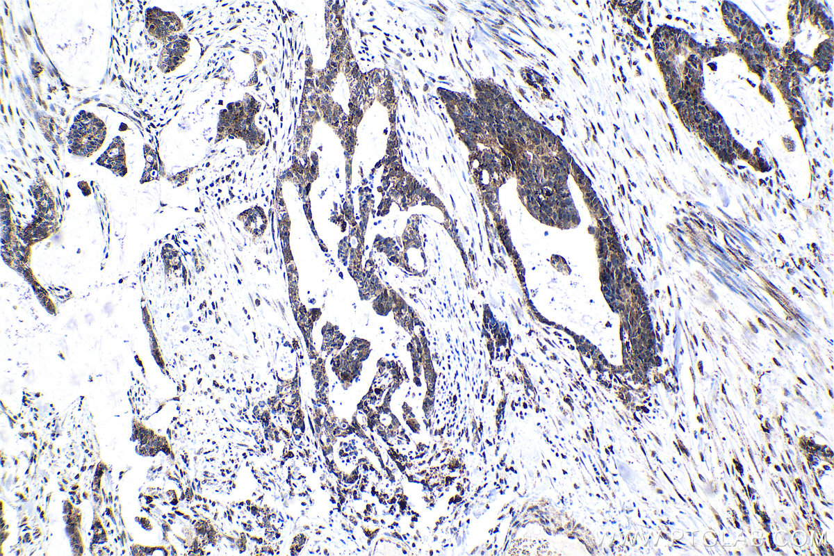 IHC staining of human urothelial carcinoma using 29770-1-AP