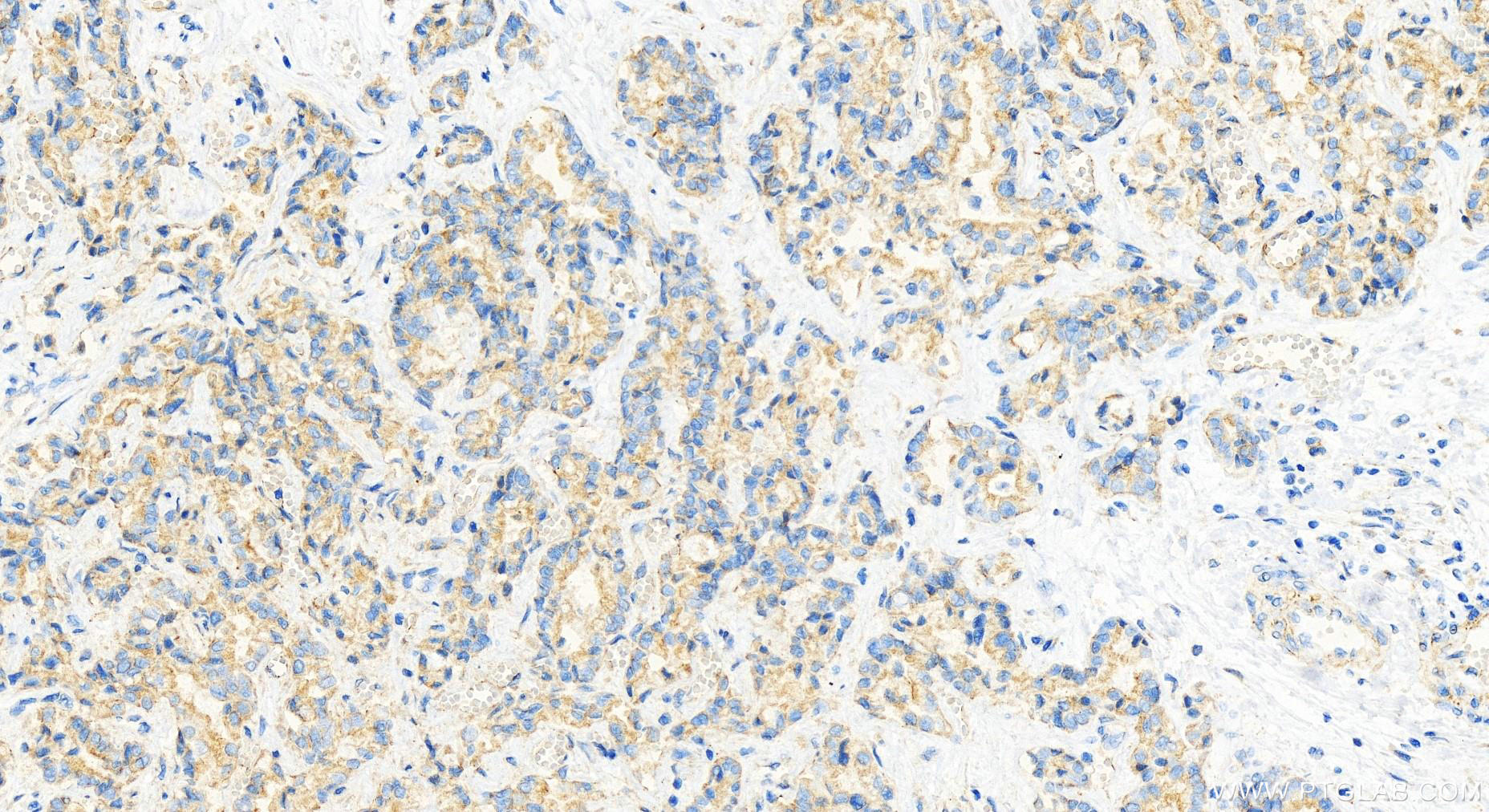 IHC staining of human intrahepatic cholangiocarcinoma using 16688-1-AP