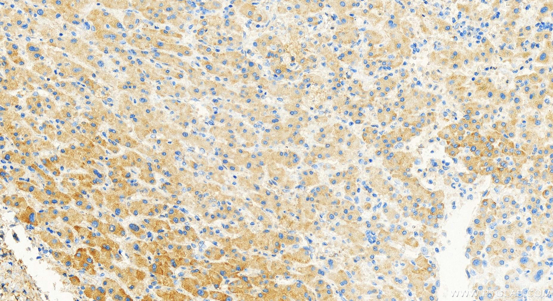 IHC staining of human intrahepatic cholangiocarcinoma using 16688-1-AP