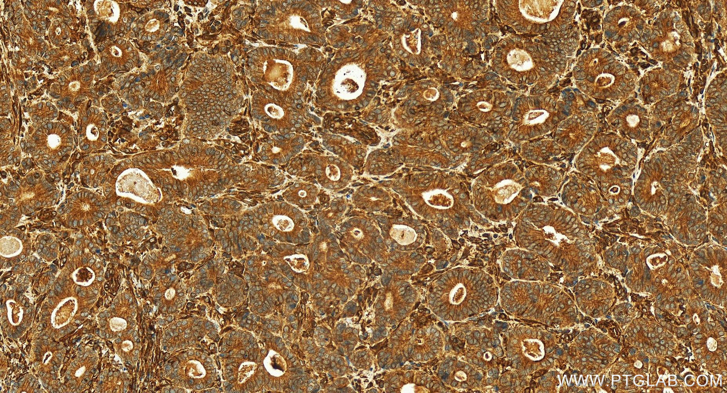 IHC staining of human stomach cancer using 16921-1-AP