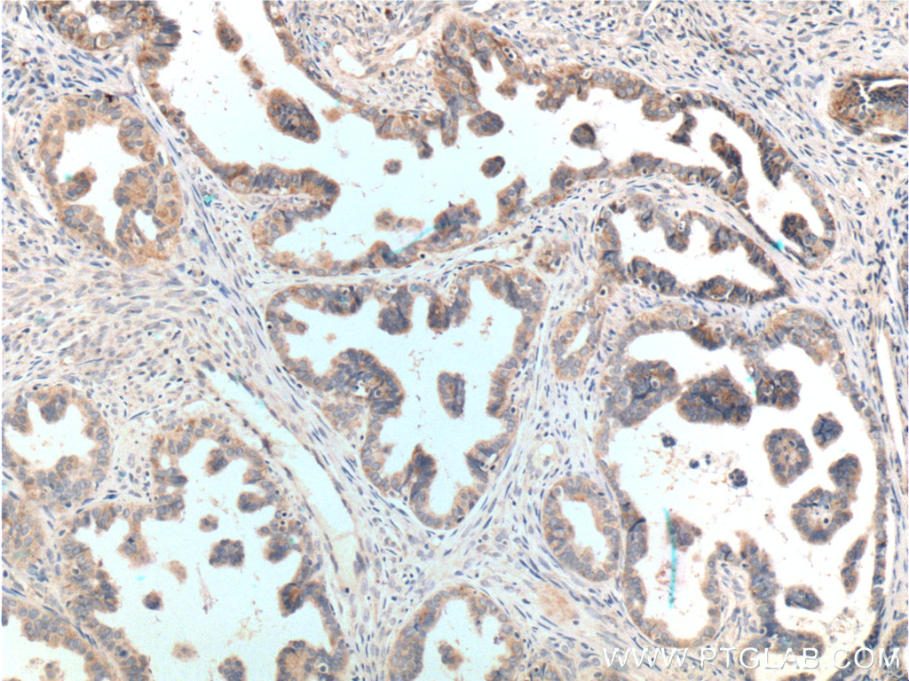 IHC staining of human ovary tumor using 13672-1-AP