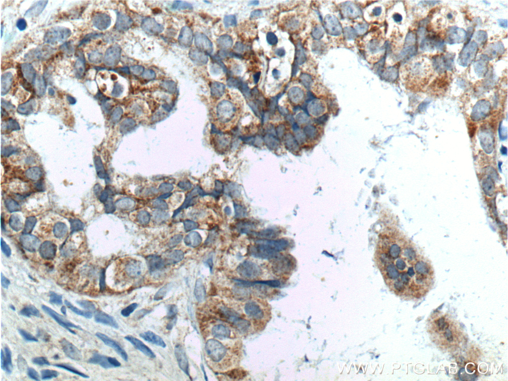 IHC staining of human ovary tumor using 13672-1-AP