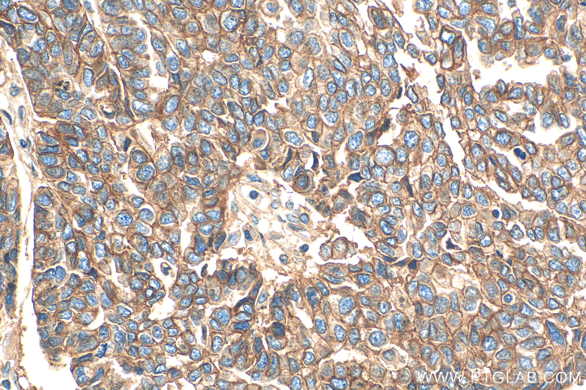IHC staining of human ovary tumor using 14418-1-AP