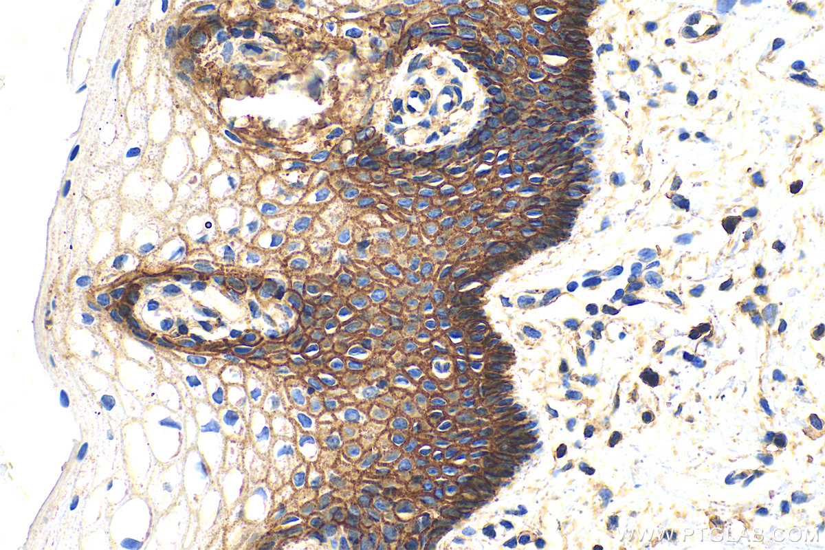 IHC staining of human cervical cancer using 14418-1-AP