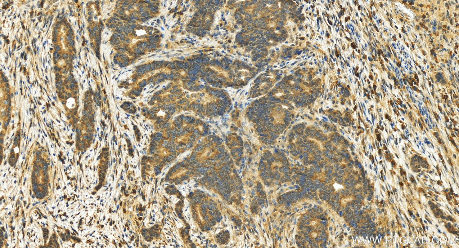 IHC staining of human stomach cancer using 18692-1-AP