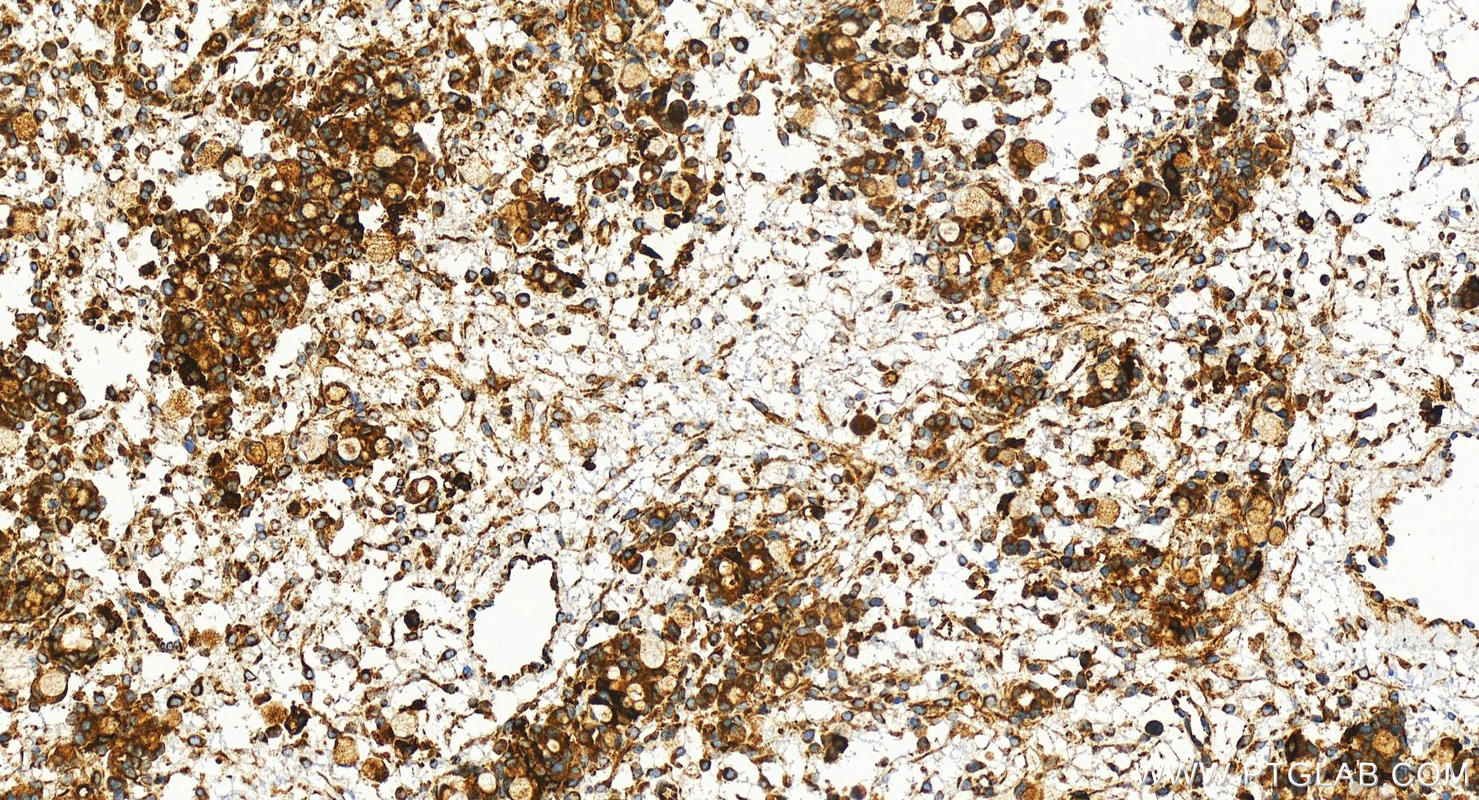 IHC staining of human ovary cancer using 83636-6-RR