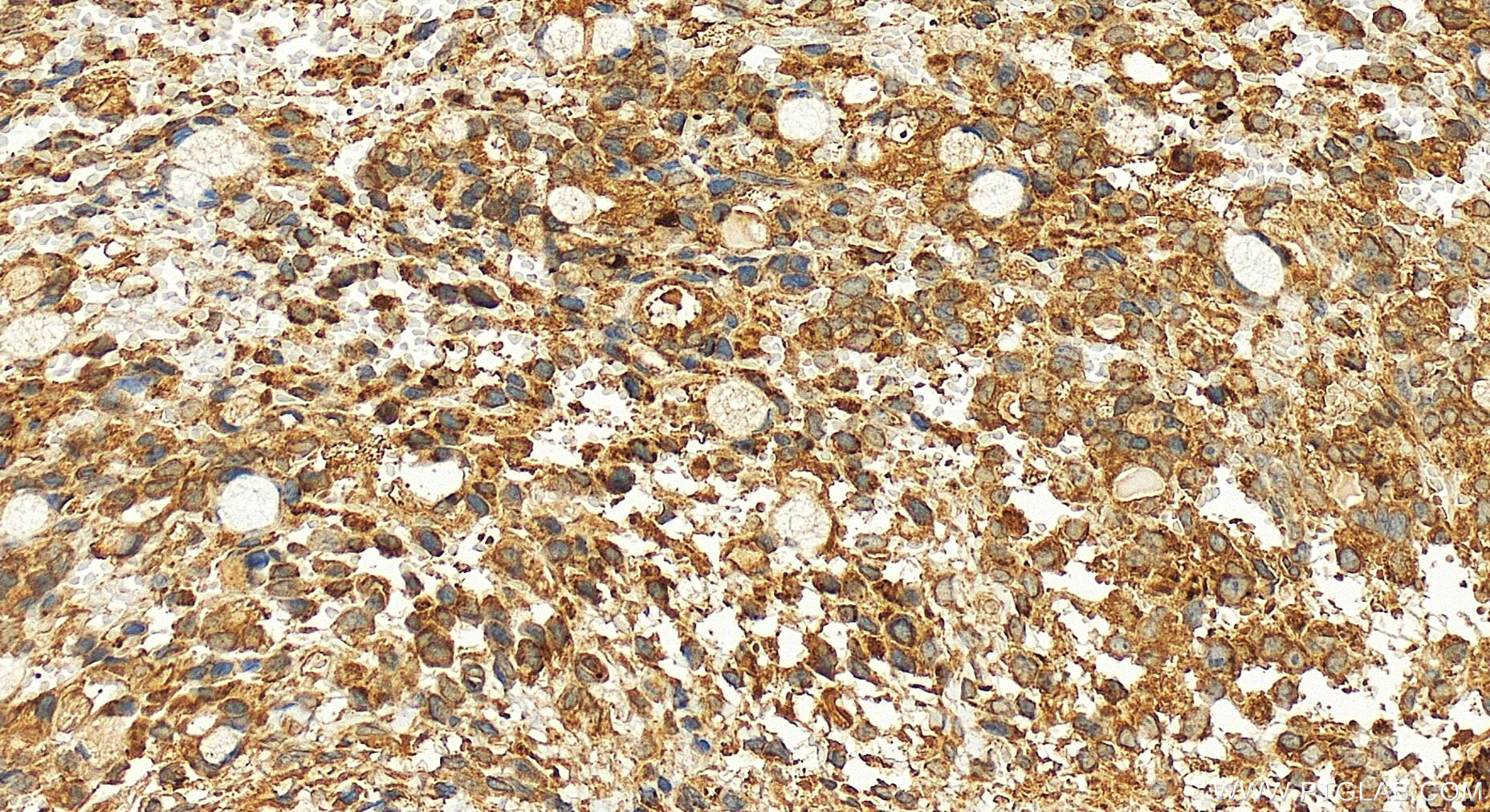 IHC staining of human ovary cancer using 18016-1-AP