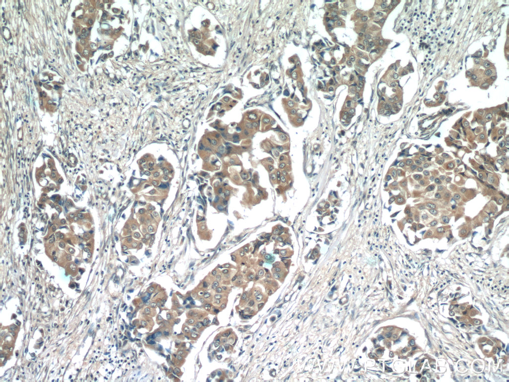 IHC staining of human breast cancer using 66178-1-Ig (same clone as 66178-1-PBS)