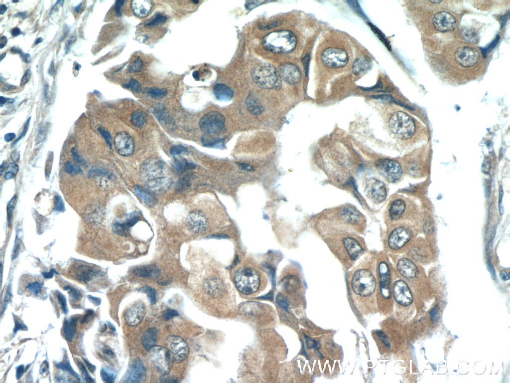 IHC staining of human breast cancer using 66178-1-Ig (same clone as 66178-1-PBS)