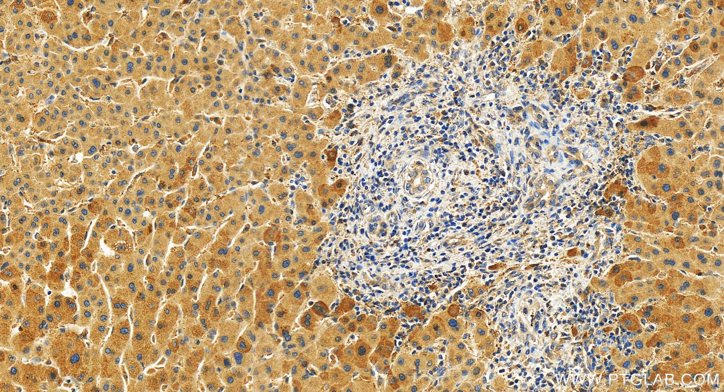 IHC staining of human intrahepatic cholangiocarcinoma using 22425-1-AP