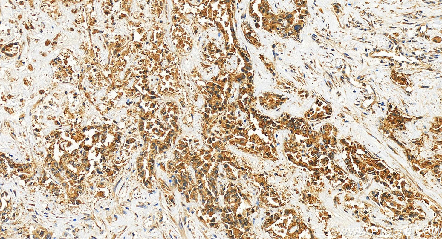 IHC staining of human intrahepatic cholangiocarcinoma using 22425-1-AP