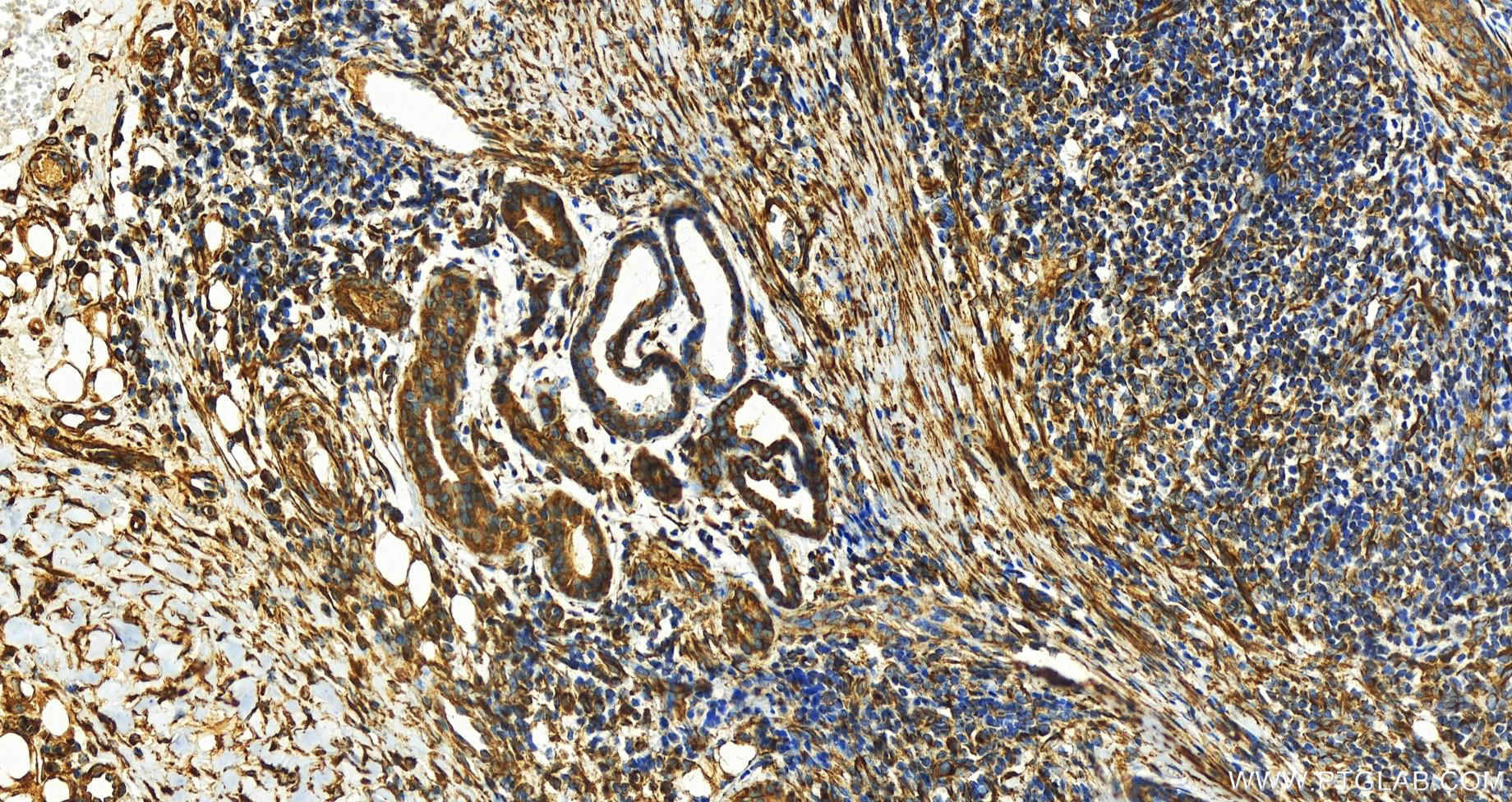 IHC staining of human skin cancer using 80762-1-RR (same clone as 80762-1-PBS)