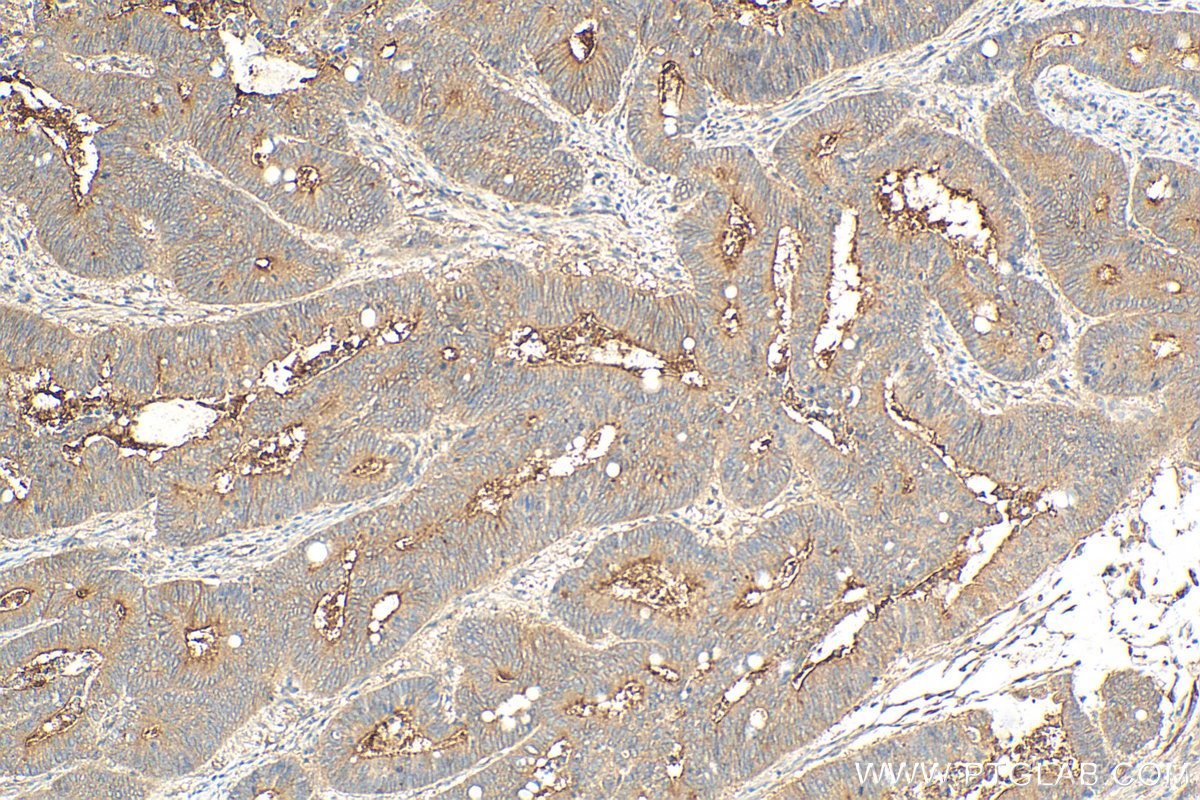 IHC staining of human colon cancer using 27093-1-AP
