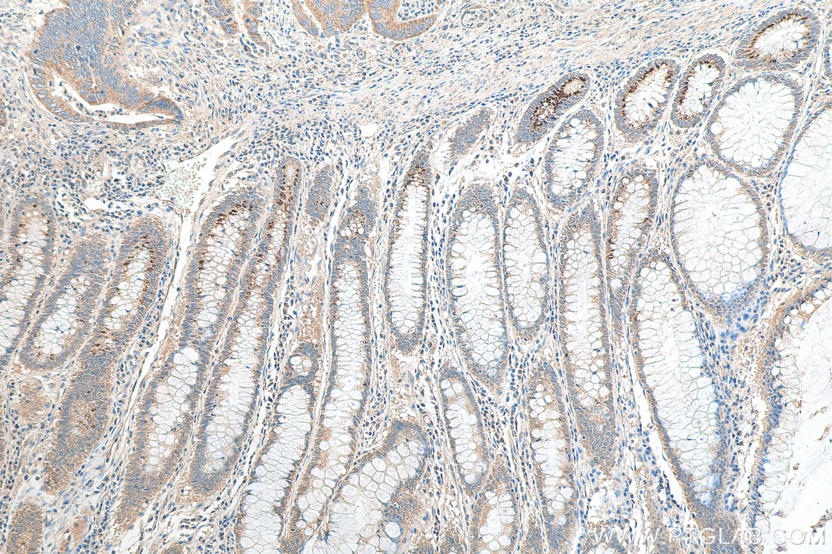 IHC staining of human colon cancer using 21291-1-AP