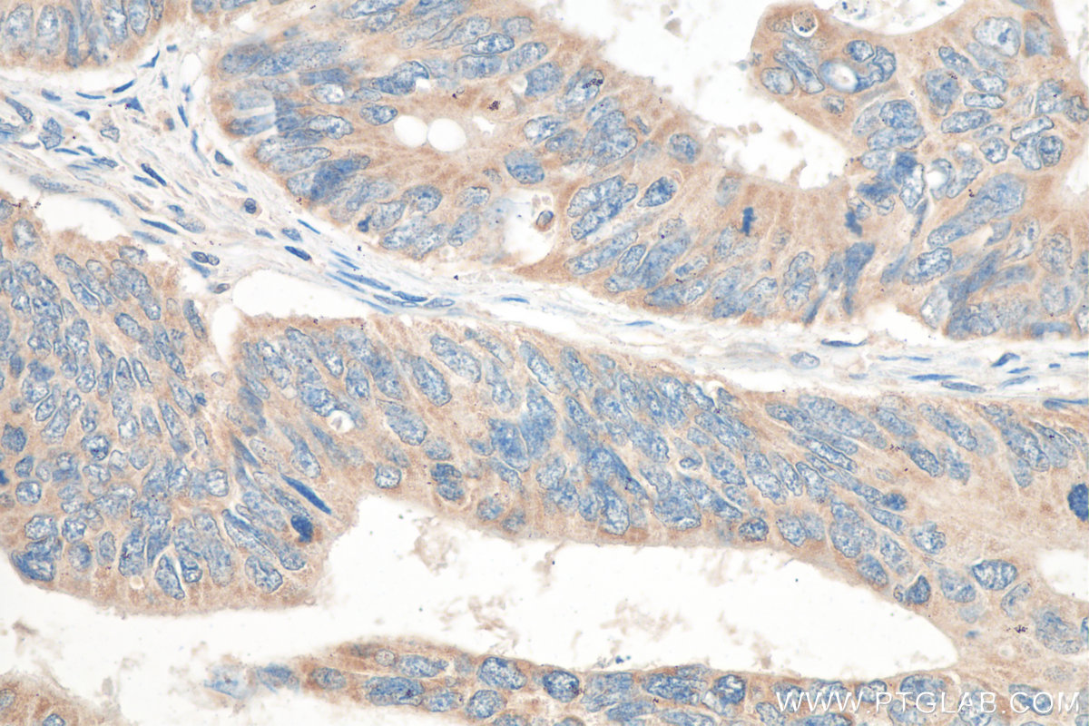 IHC staining of human colon cancer using 21291-1-AP