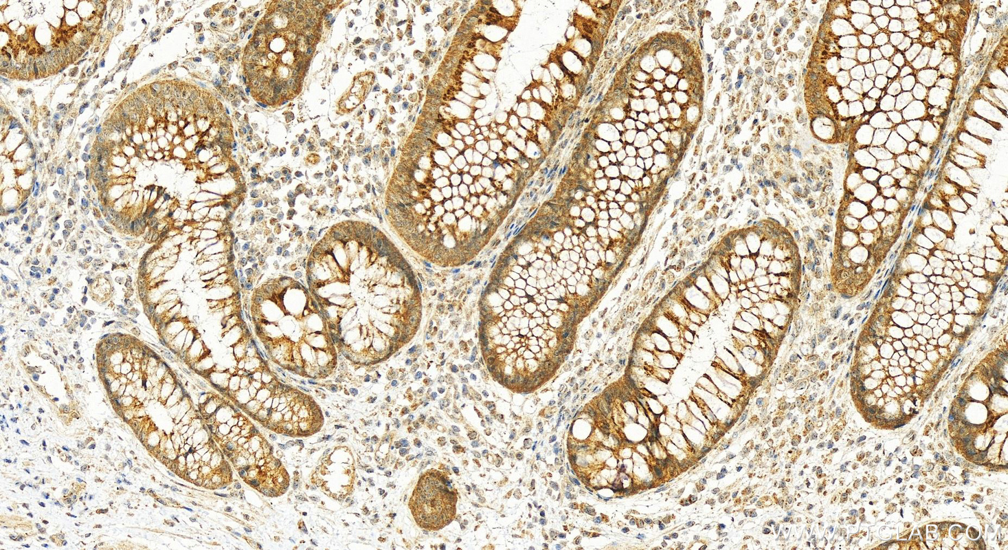 IHC staining of human colon cancer using 22879-1-AP