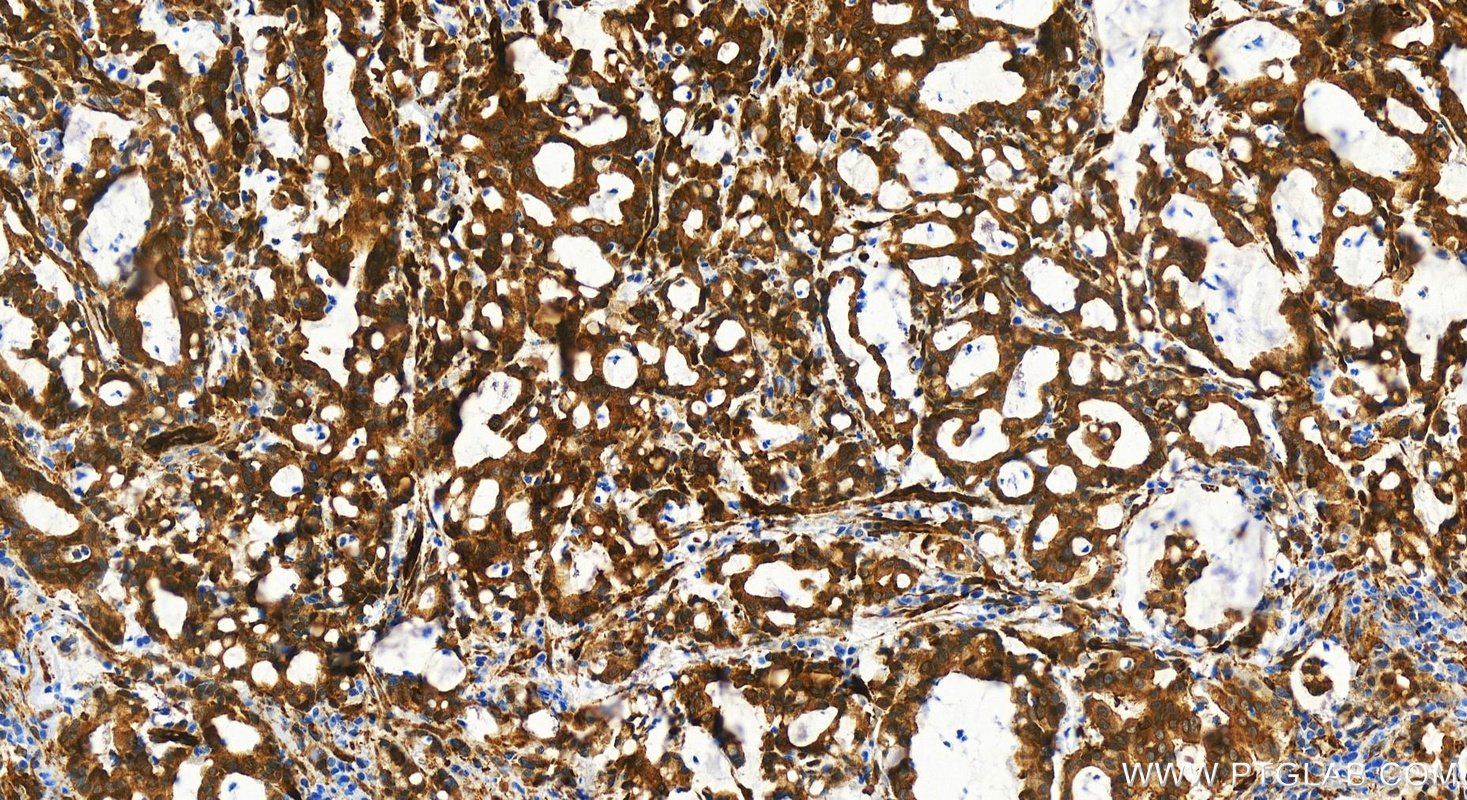 IHC staining of human stomach cancer using 83779-4-RR (same clone as 83779-4-PBS)