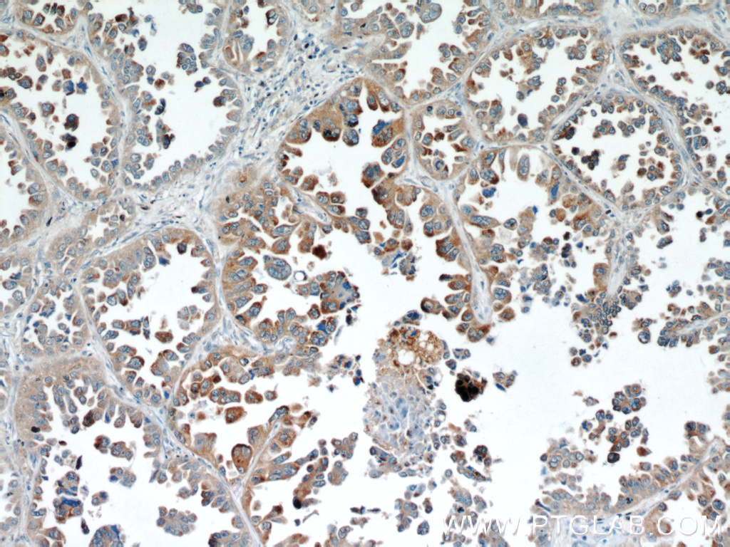 IHC staining of human lung cancer using 20071-1-AP