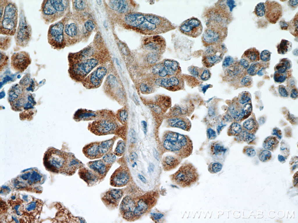 IHC staining of human lung cancer using 20071-1-AP