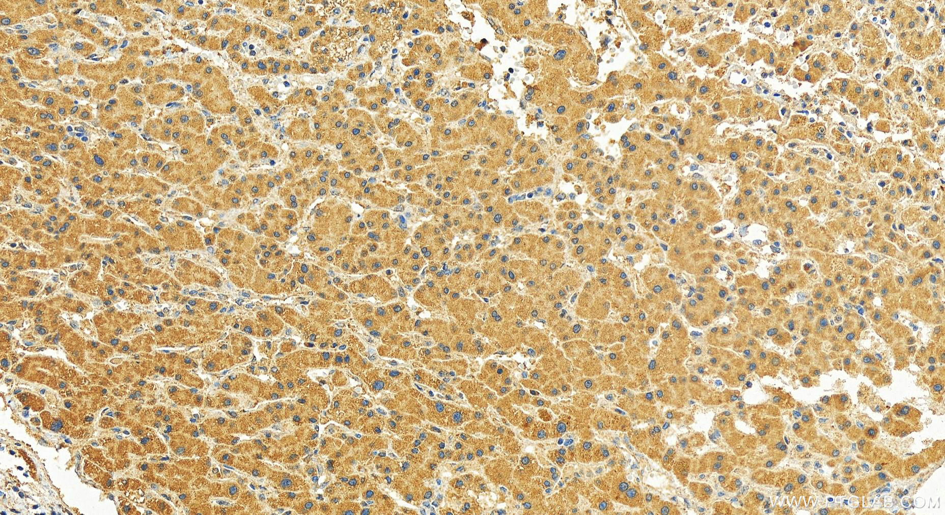 IHC staining of human intrahepatic cholangiocarcinoma using 16738-1-AP