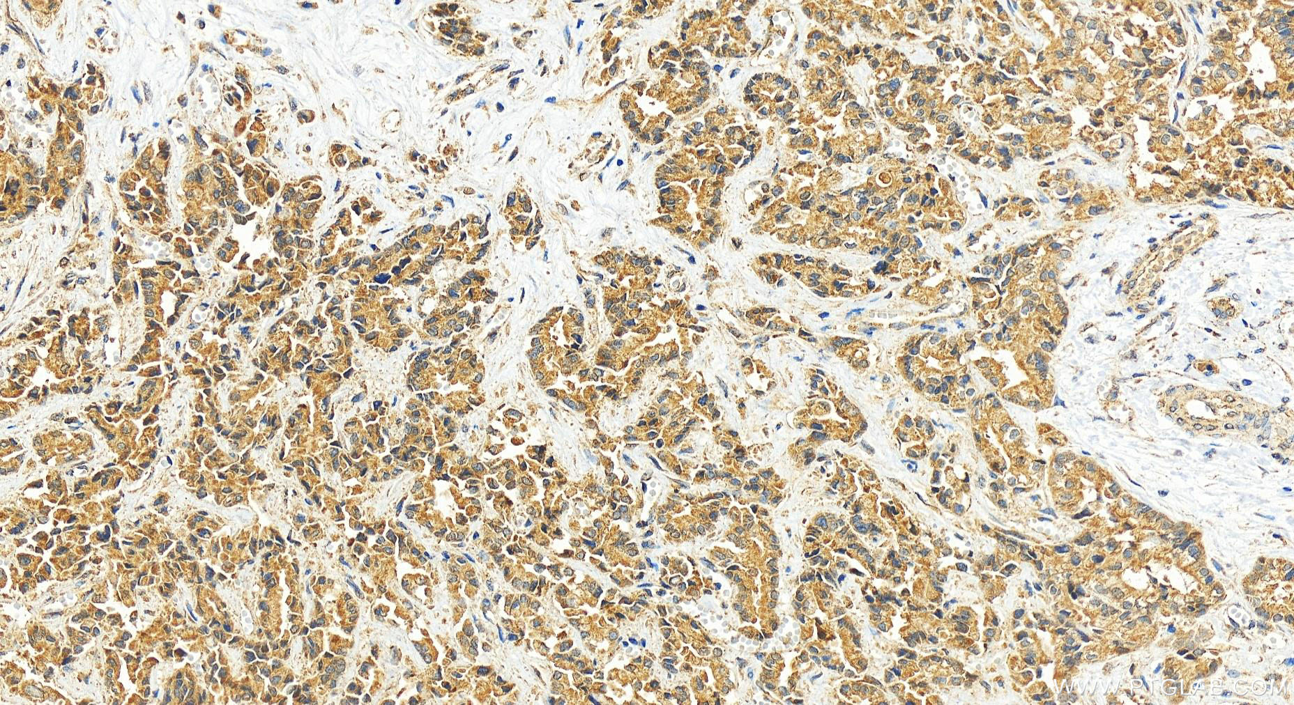 IHC staining of human intrahepatic cholangiocarcinoma using 16738-1-AP