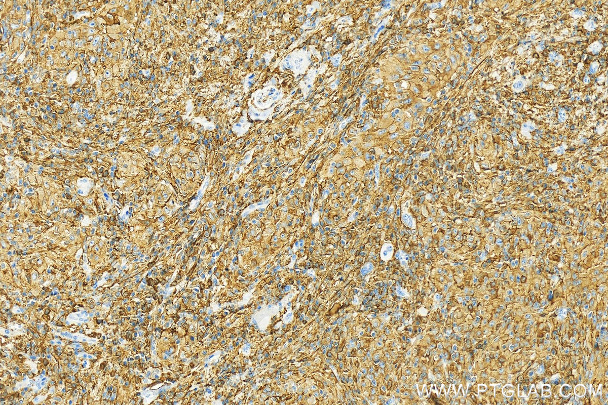 IHC staining of human skin cancer using 14880-1-AP