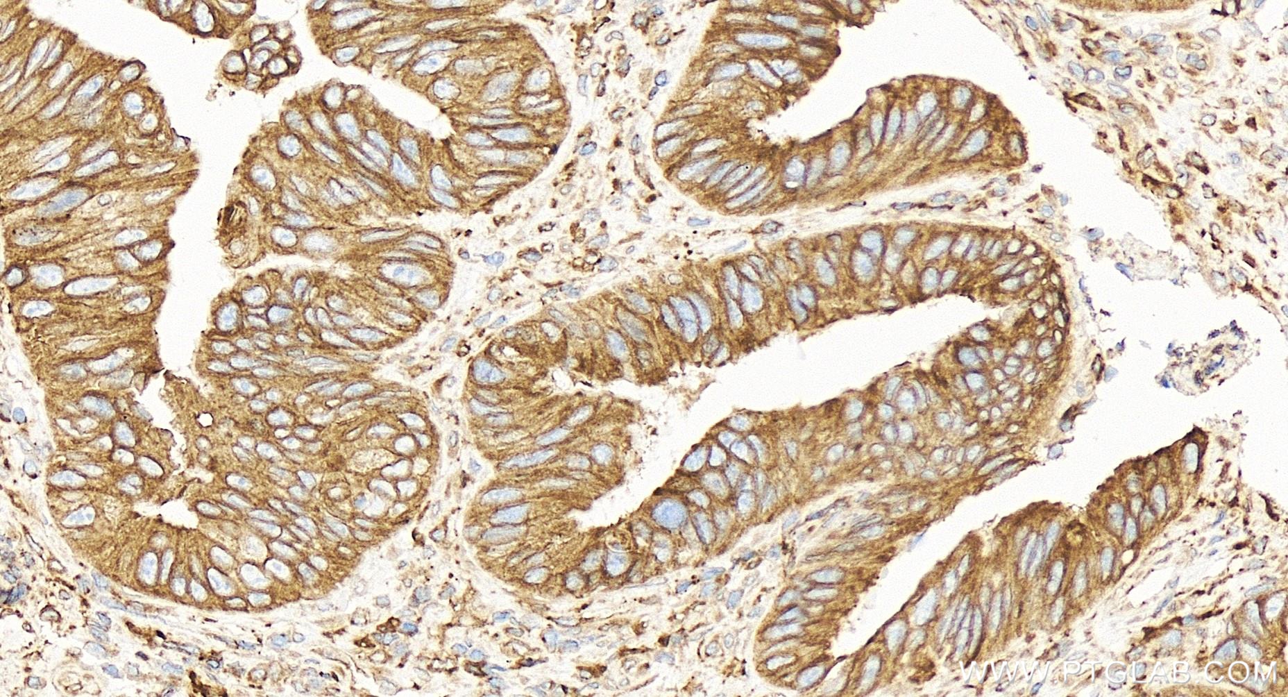 IHC staining of human colon cancer using 84584-5-RR