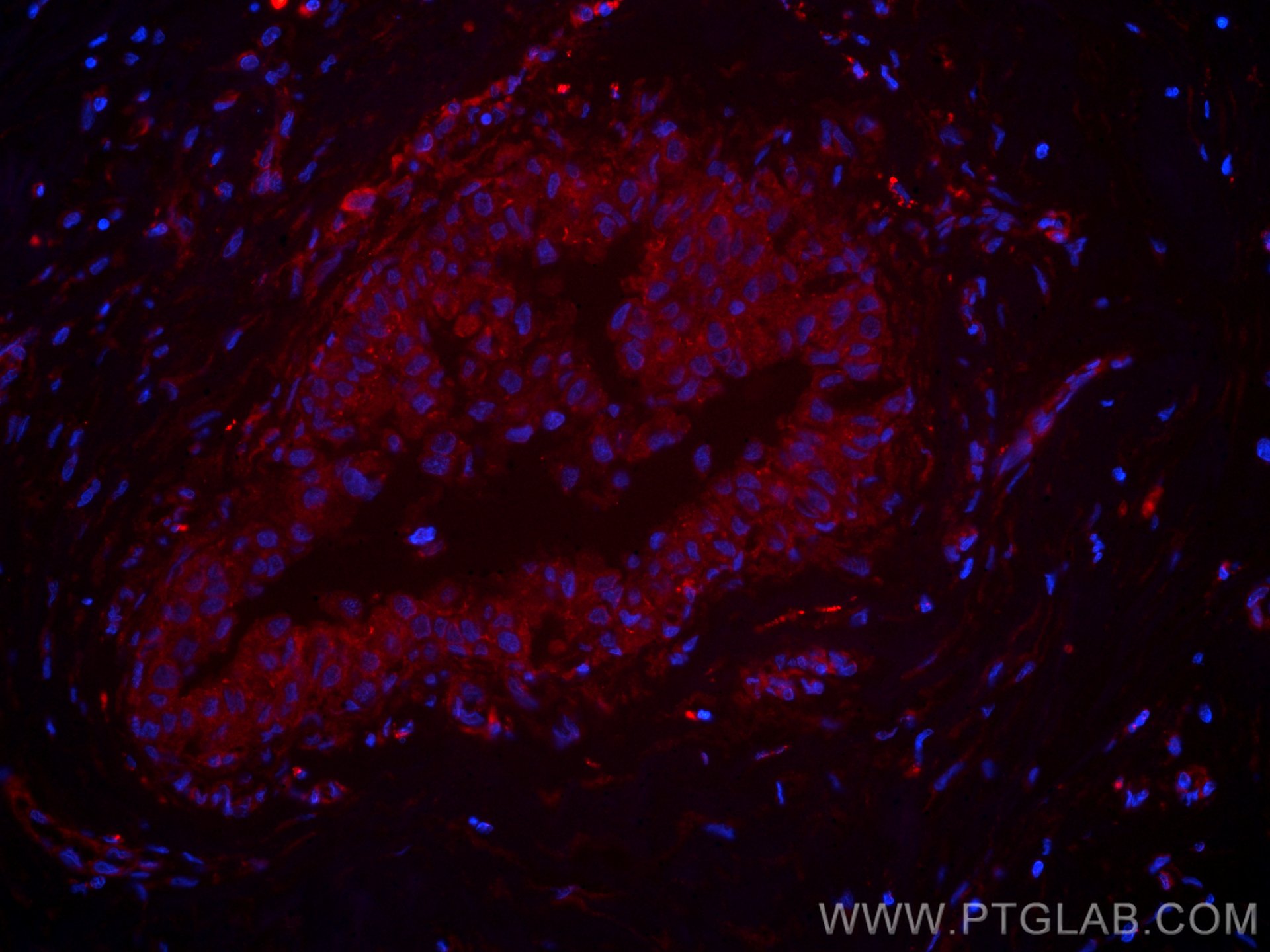 IF Staining of human breast cancer using CL594-67215