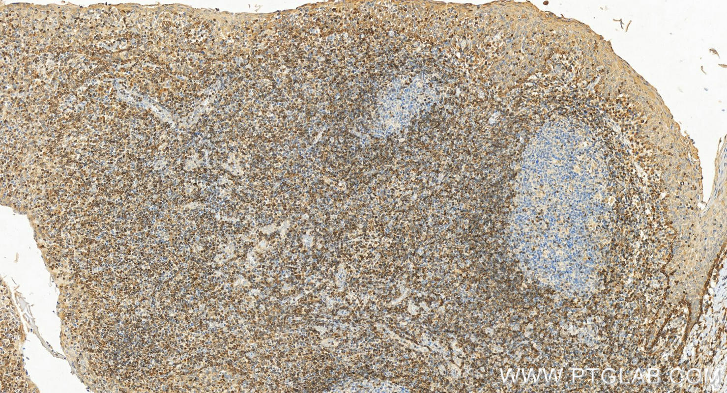 IHC staining of human tonsillitis using 12789-1-AP