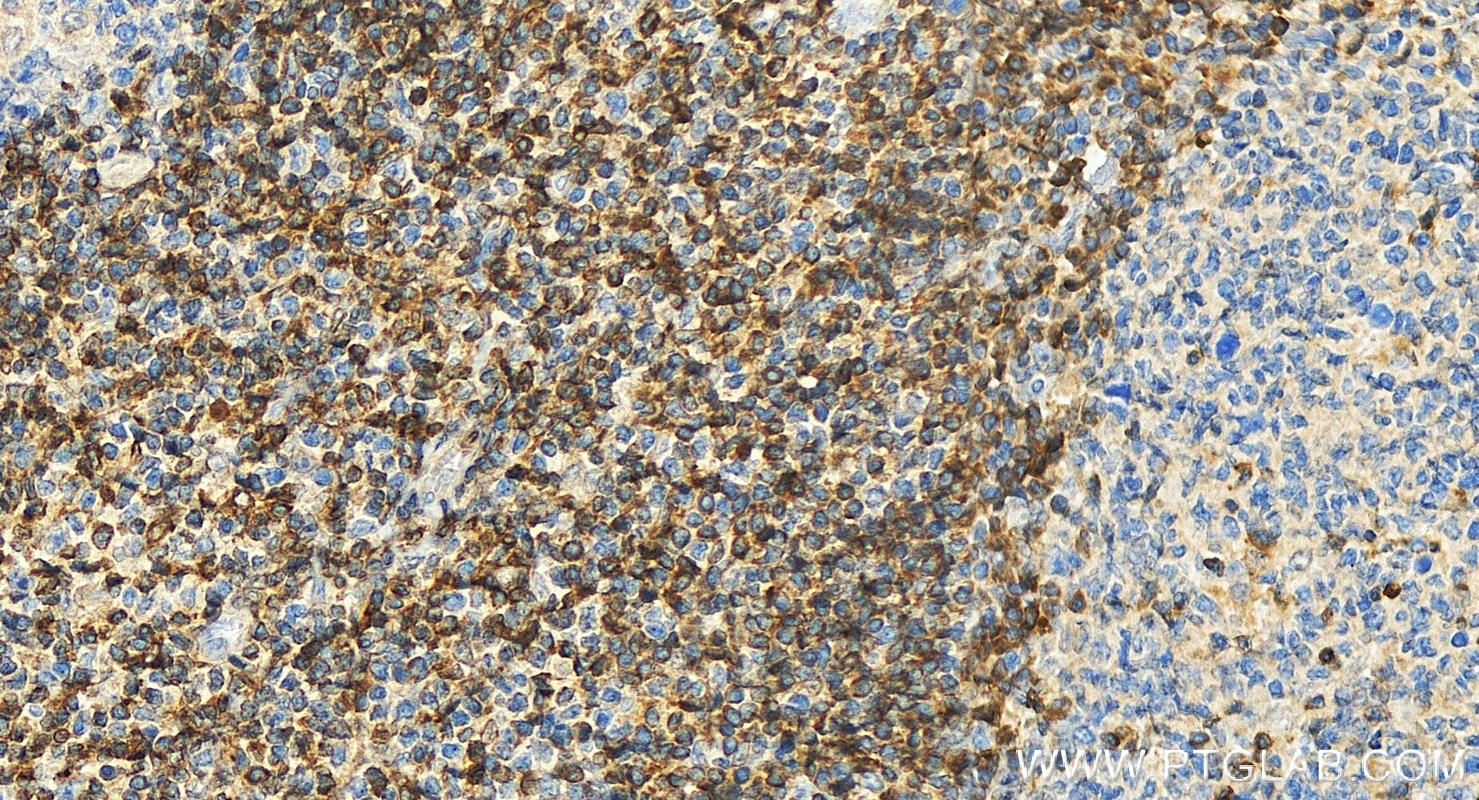 IHC staining of human tonsillitis using 12789-1-AP