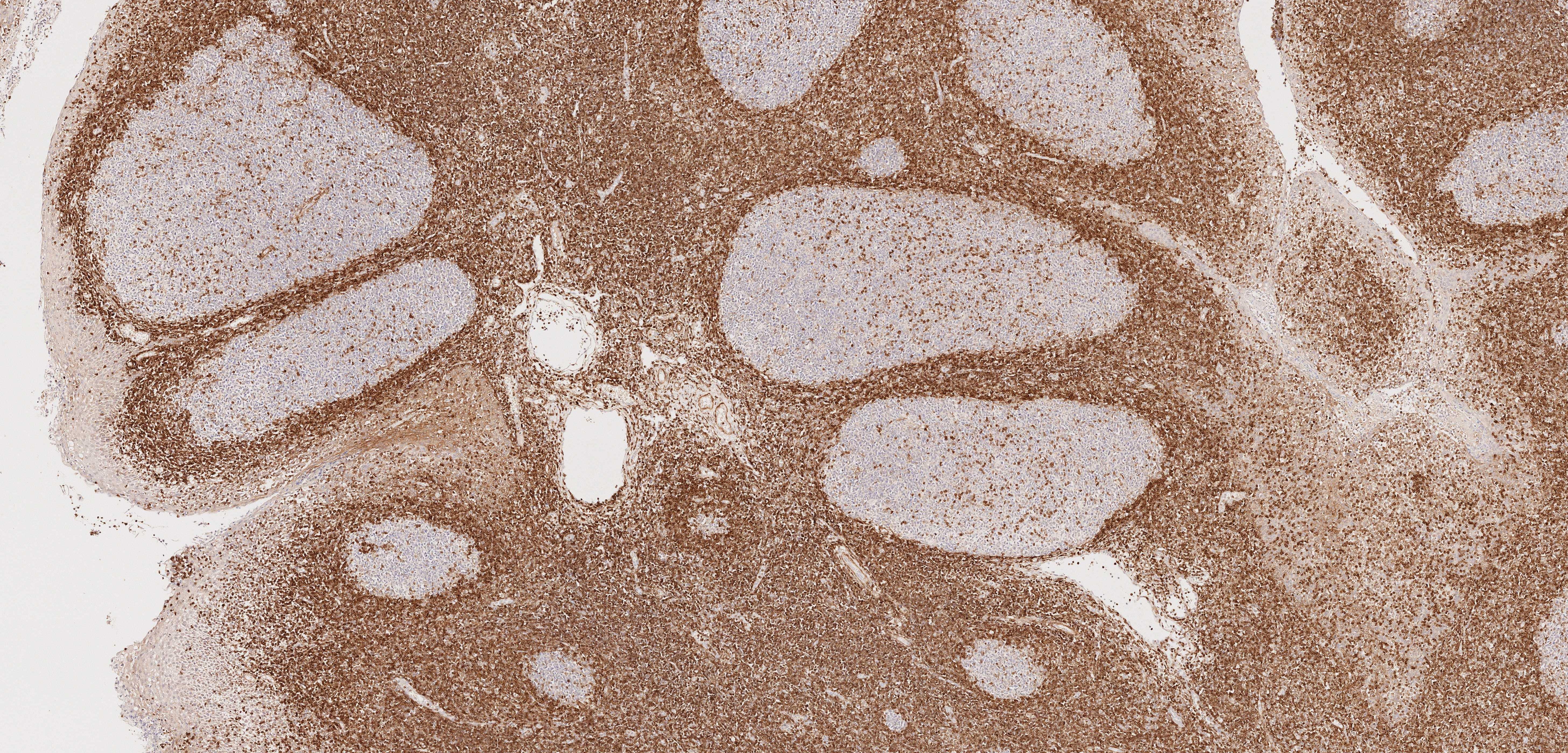 IHC staining of human tonsillitis using 60178-1-Ig