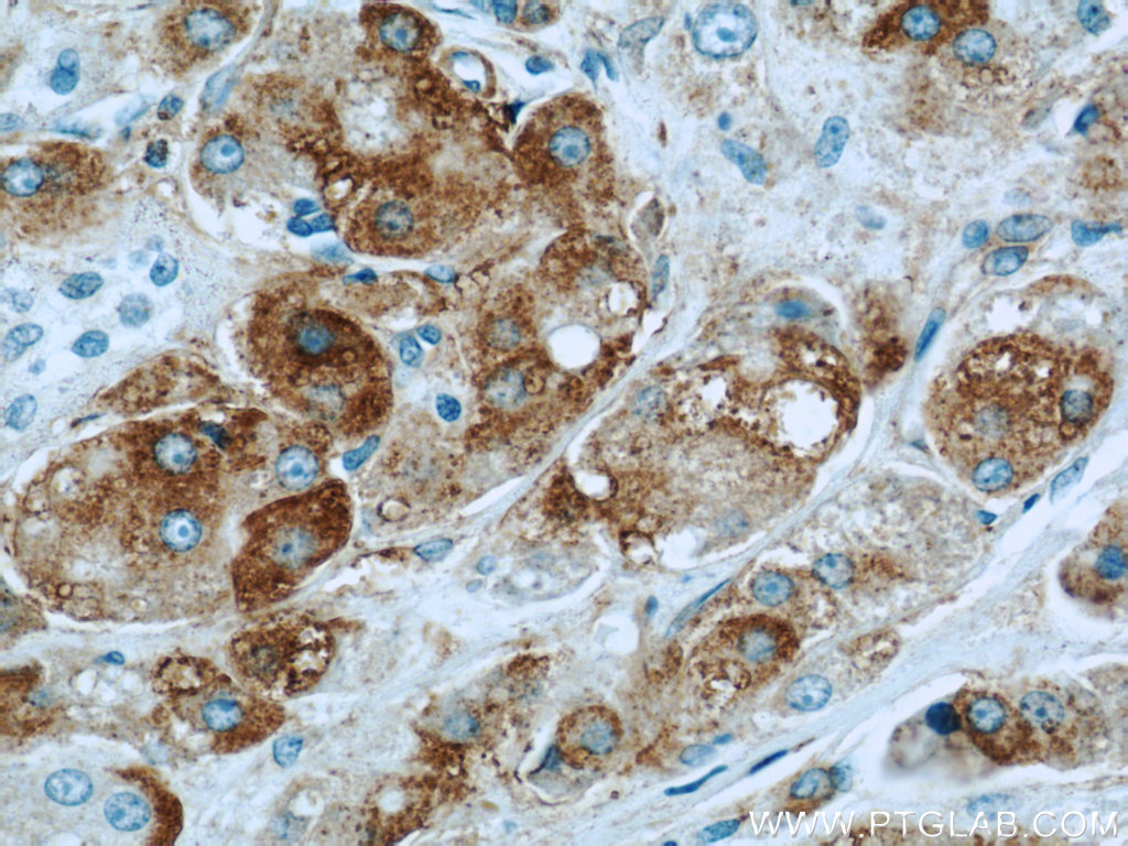 IHC staining of human breast cancer using 21969-1-AP