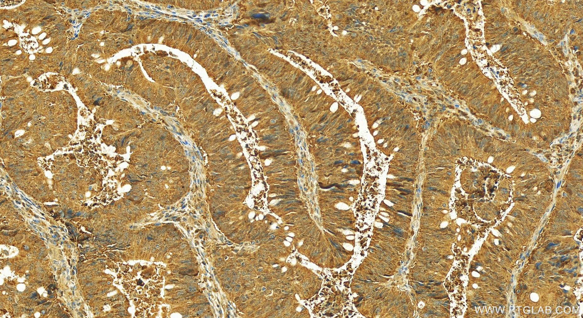 IHC staining of human colon cancer using 23975-1-AP