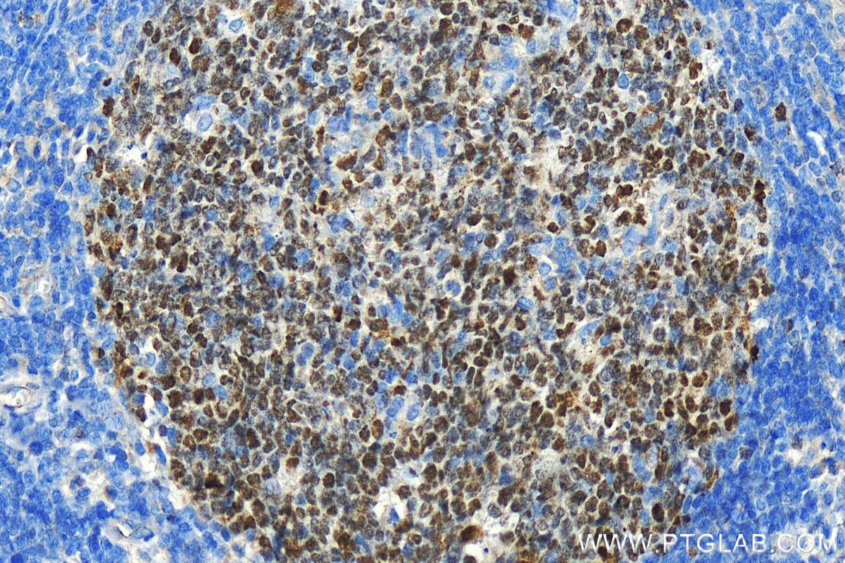 IHC staining of human tonsillitis using 21187-1-AP